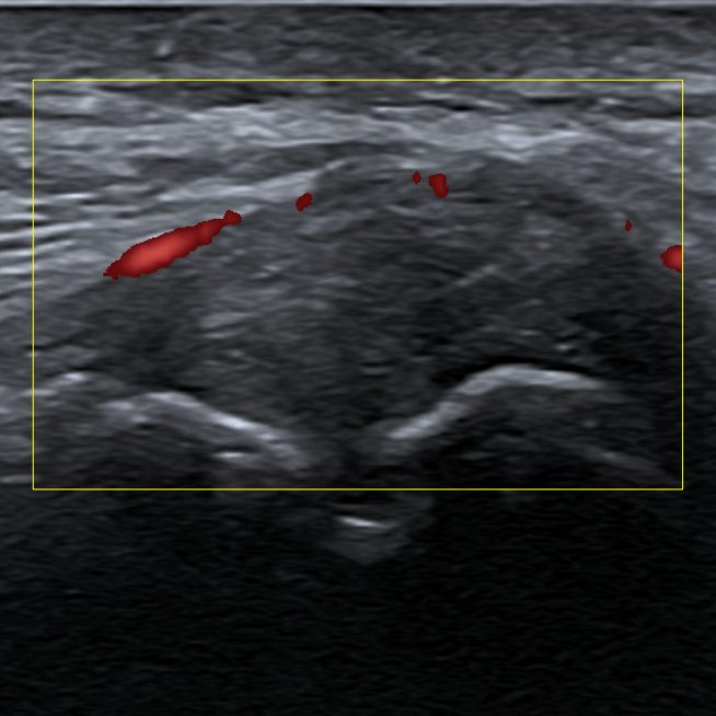 staw barkowo-obojczykowy power doppler
